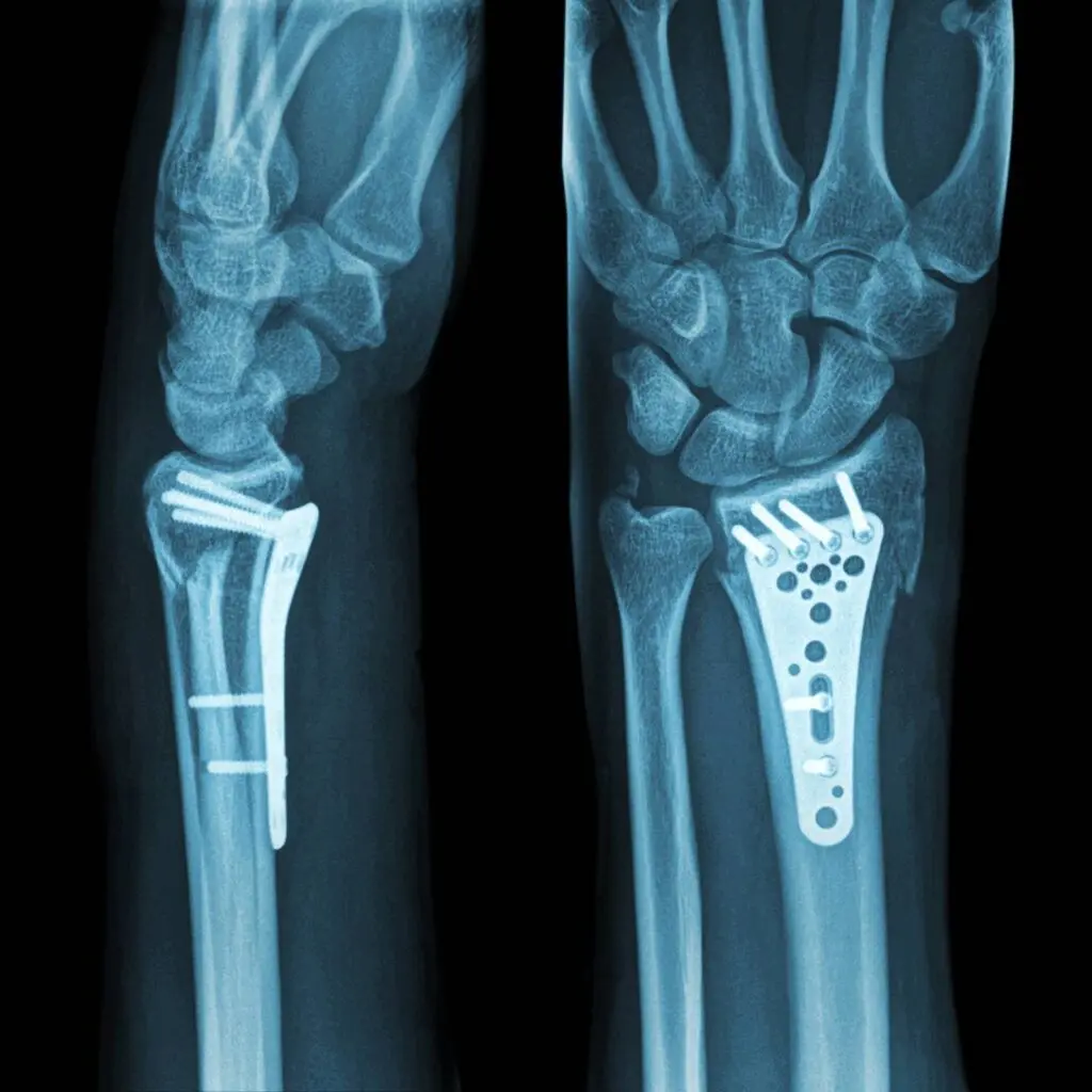 X-ray image of a person's fractured wrist, stabilized by medical plate and bone screws.