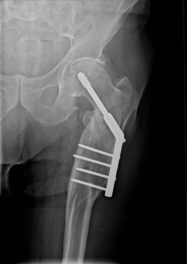 An X-ray image of a person's leg fracture, stabilized by a dynamic hip screen with long medical plating.