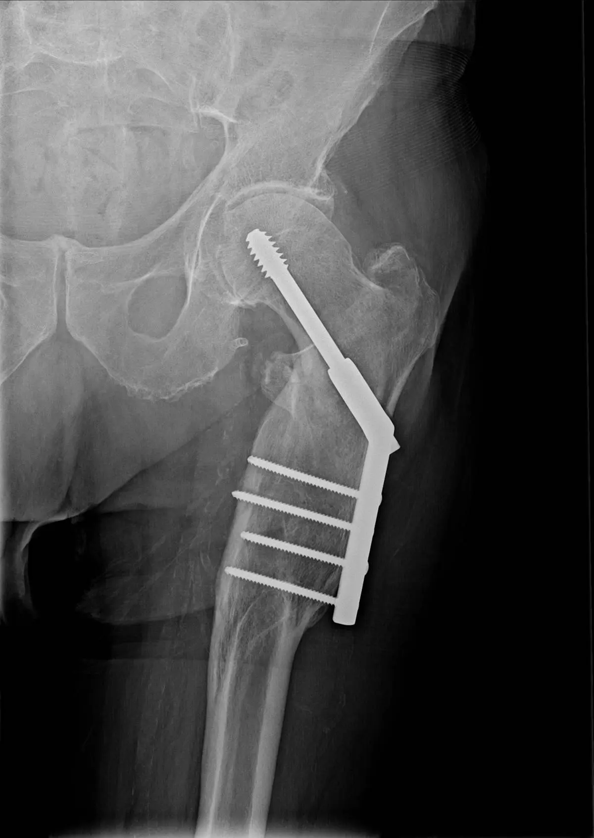 x-ray_showing_fracture_after_stabilization_with_dynamic_hip_screw_with_long_plate