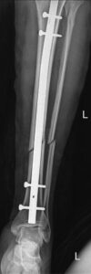 Medical Intramedullary Nails Inspection and Measurement