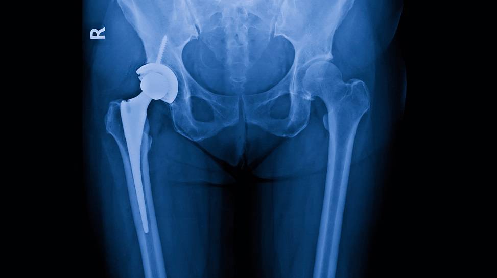 hip stem replacement - radiograph