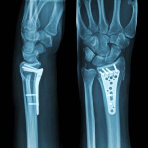 X-ray of wrist fracture stabilized with plate and bone screws