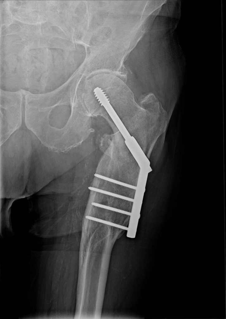 X-ray showing fracture after stabilization with dynamic hip screw with long plate